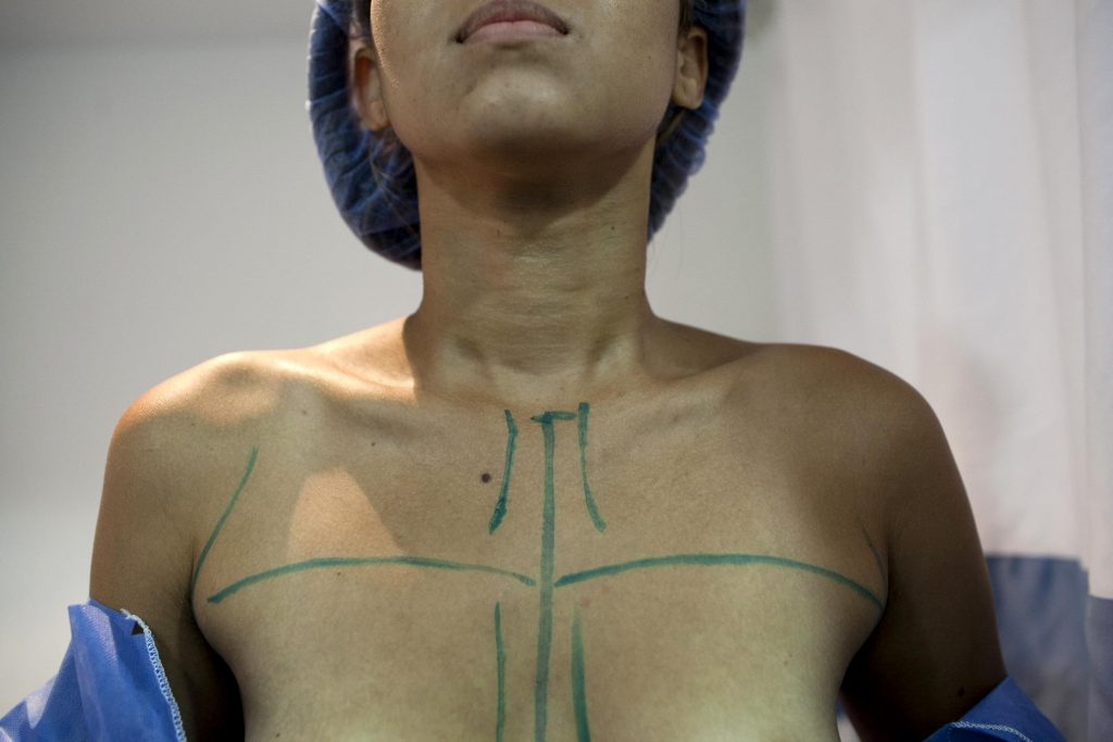 Тубулярная деформация груди